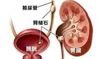 肾结石怎样治最好